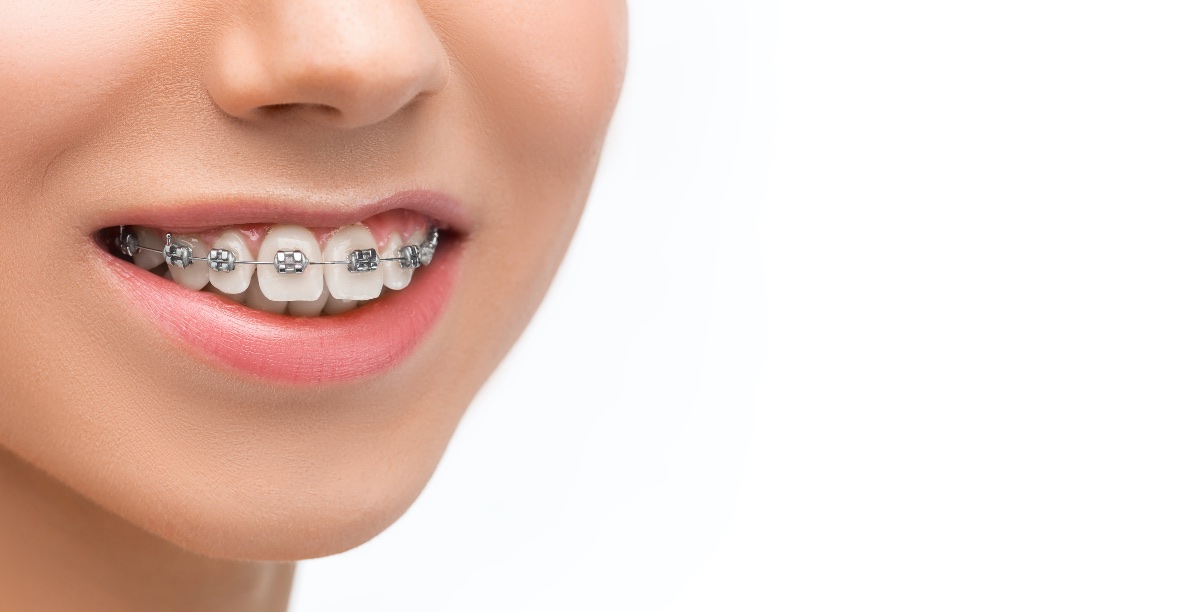 ¡Vuelta al Cole! 15% de descuento en tu ortodoncia en Vasaldora Clínica Dental