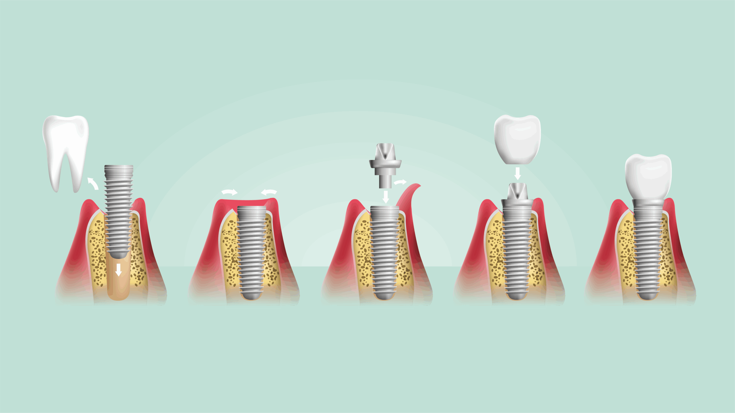 ¿Cuándo son aconsejables los implantes dentales?