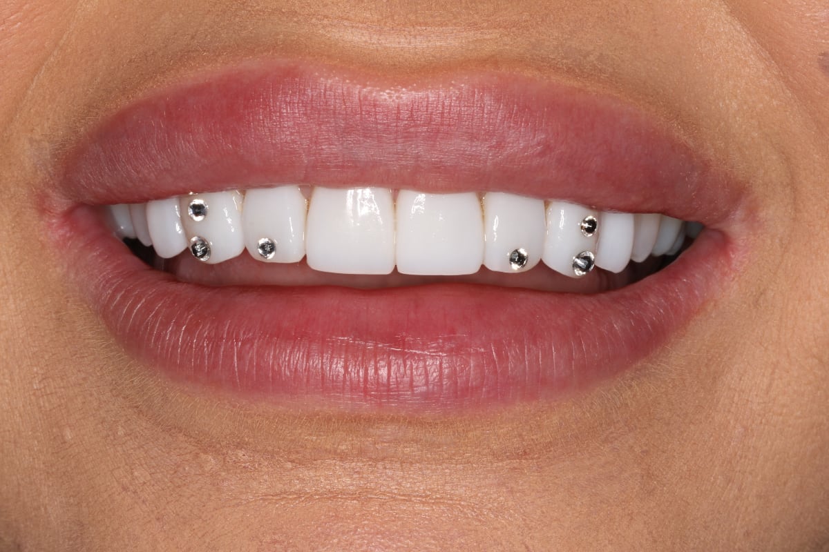 Brillantes dentales: todo lo que tienes que saber